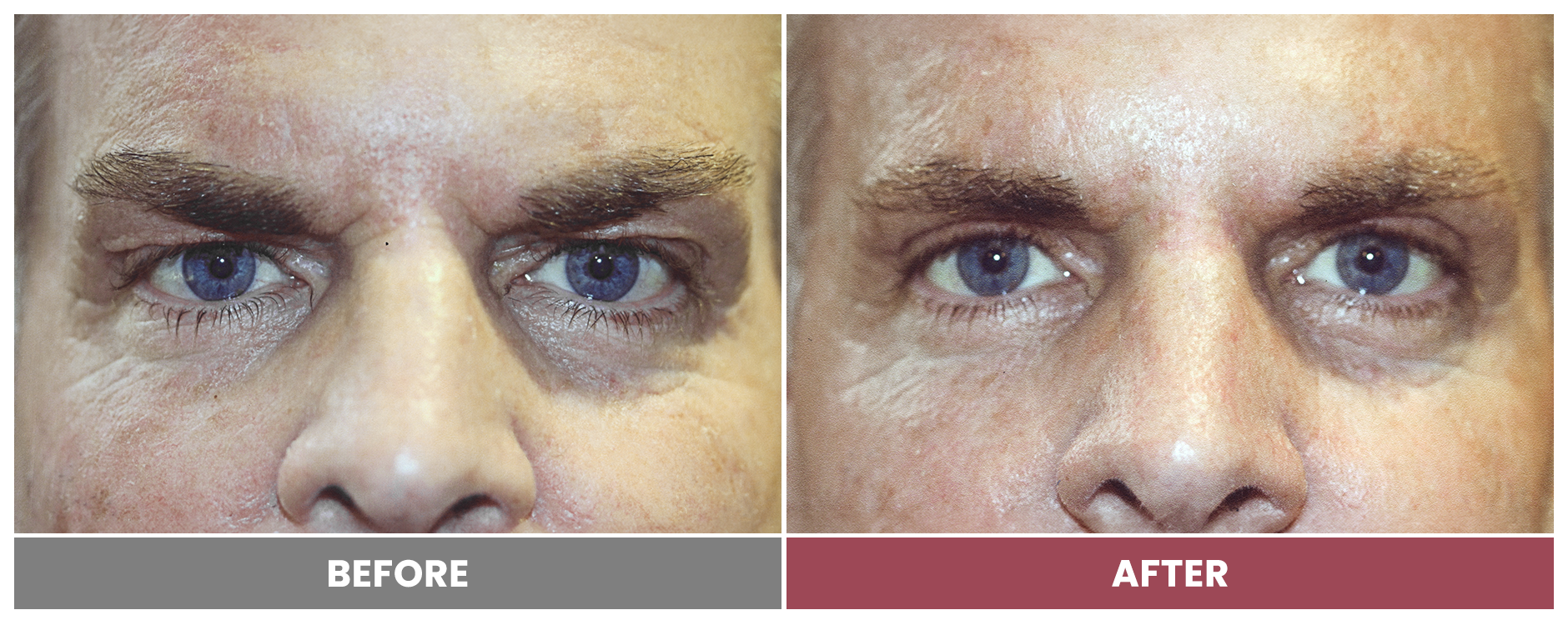 Upper Blepharoplasty - Case 8